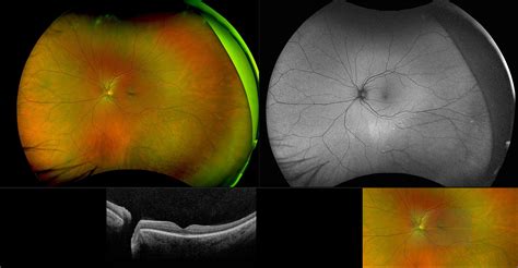 California - Retinoschisis, RG