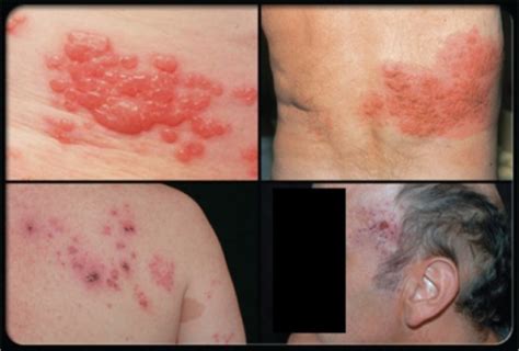 Shingles Rash On Chest