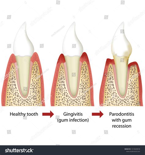 Stages Periodontitis Medical Vector Illustration White Stock Vector ...