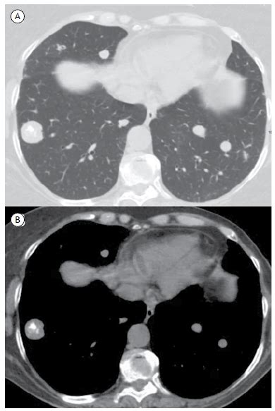 Scielo Brasil Ct Features Of Osteosarcoma Lung Metastasis A