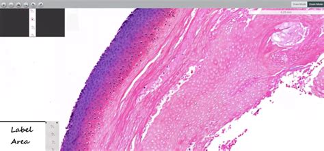 What Do You Know about Pilomatricoma? - PathologyWatch