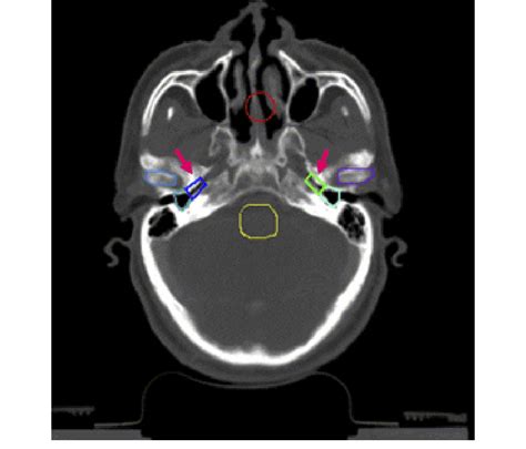 Contouring Of The Middle Ear Cavity And The Isthmus Of The Eustachian