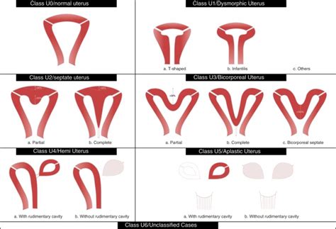 ESHRE/ESGE classification of uterine anomalies: schematic... | Download ...