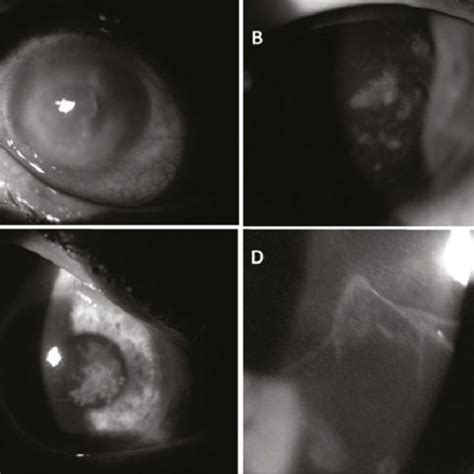 Pdf Non Contact Lens Use Related Acanthamoeba Keratitis In Southern Turkey Evaluation Of Risk