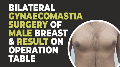 Bilateral Gynecomastia Surgery Results Before And After Results Dr