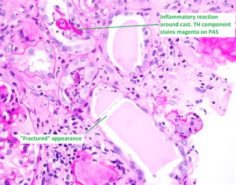 Kidney Biopsy Of The Month Light Chain Cast Nephropathy Renal Fellow