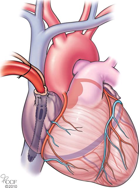 Basics Of Cardiopulmonary Bypass Normal And Abnormal Postoperative Ct Appearances Radiographics