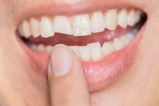 Quanto Tempo Demora Para Nascer Um Dente Tua Sa De