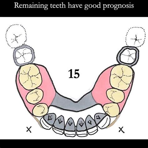 Universal Scandinavian partial denture designs | Finlay Sutton - Denture Education