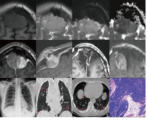 Postoperative Progression Of Intracranial Grade IIIII Solitary Fibrous