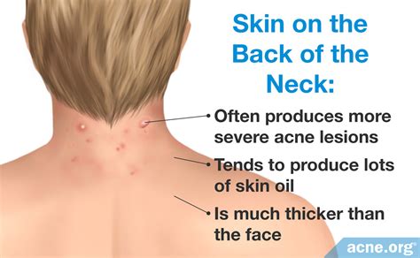 Neck Acne Treatment Online | cityofclovis.org