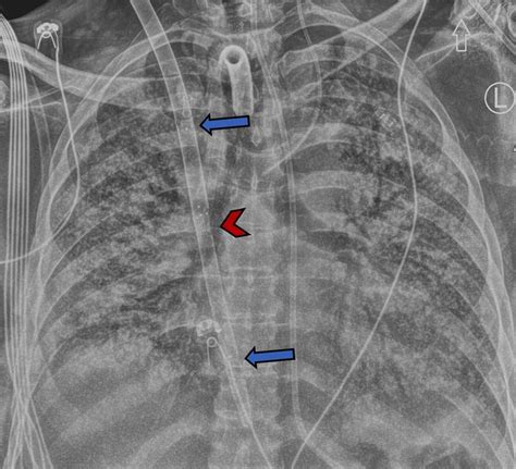 Extracorporeal Membrane Oxygenation Ecmo Catheter