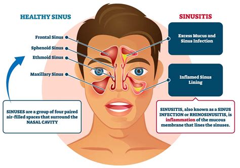 Sinusitis Allergy And Asthma Network