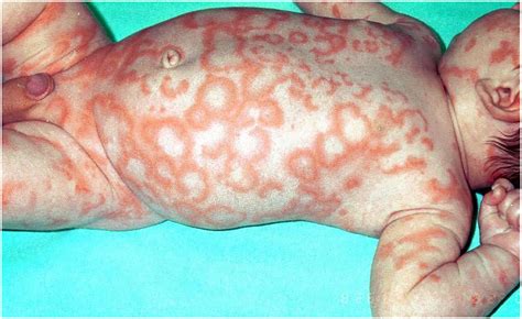 The Rash That Presents As Target Lesions Clinics In Dermatology