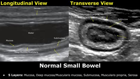 SOLUTION: Small Bowel Ultrasound Normal Vs Abnormal Image Appearances Comparison - Studypool