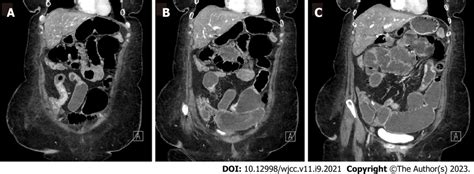 Computed Tomography Enterography Demonstrating Multifocal Stricturing