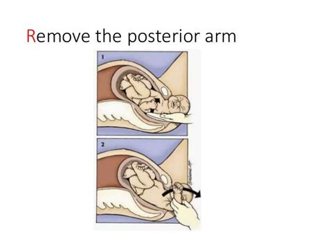 Gaskin Maneuver Shoulder Dystocia