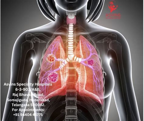 Understanding Stage 4 Lung Cancer Symptoms - Asvins Specialty Hospitals