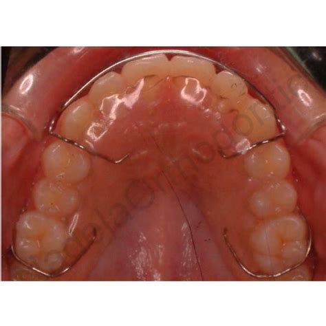 Hawley Retainer Orthodontics Orthodontic Training Dental Training