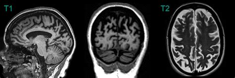 Posterior Cortical Atrophy PCA NEURORADIOLOGY