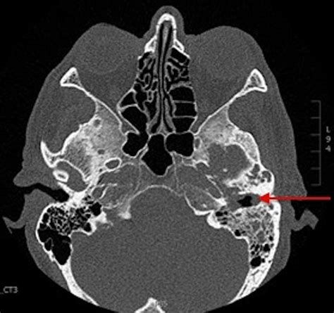 Otitis Media CT Scan