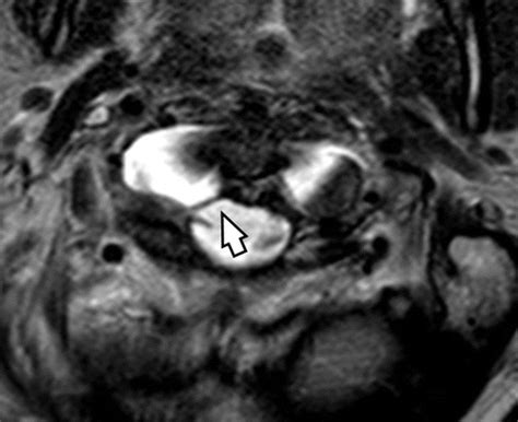 Atlanto Occipital Joint Xray