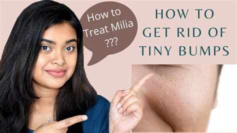 How To Treat Tiny Bumps On Forehead How To Get Rid Of Tiny Bumps On