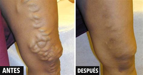 Remedios Para Tratar Las Varices O Venas Varicosas Sin Cirug A