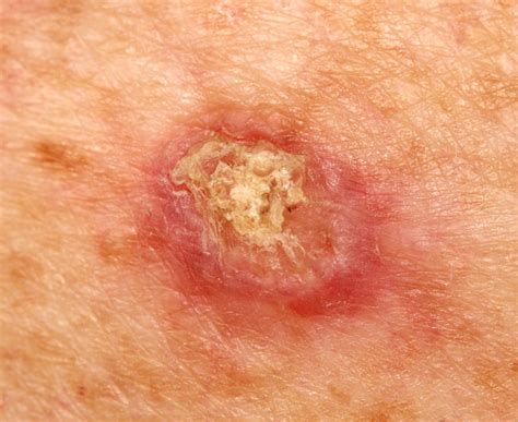 Squamous Cell Carcinoma Front Range Dermatology