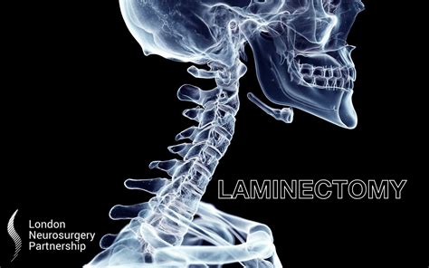 Laminectomy - London Neurosurgery - Spine & Neurosurgery