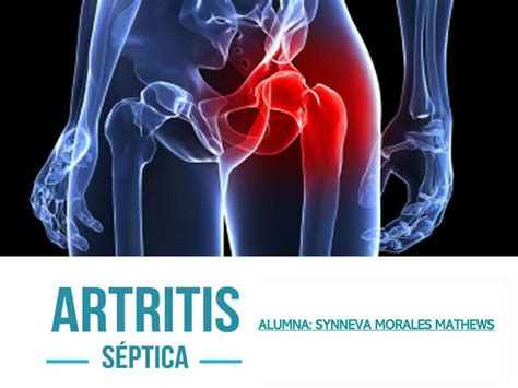 Artritis Séptica Synneva Morales Mathews uDocz