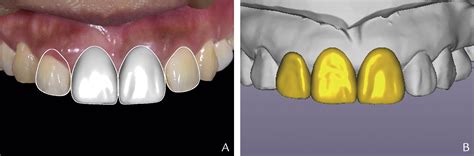 A Digitally Guided Dual Technique For Both Gingival And Bone Resection