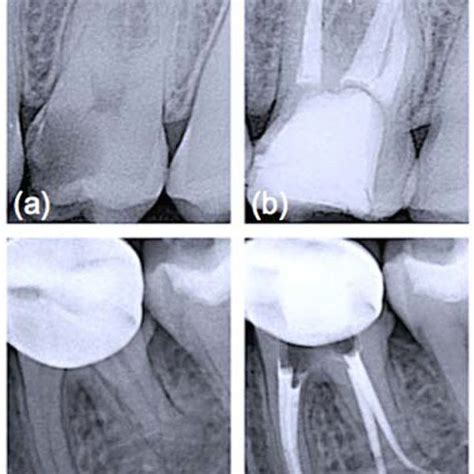 Periapical X Rays Before And After Root Canal Treatments A