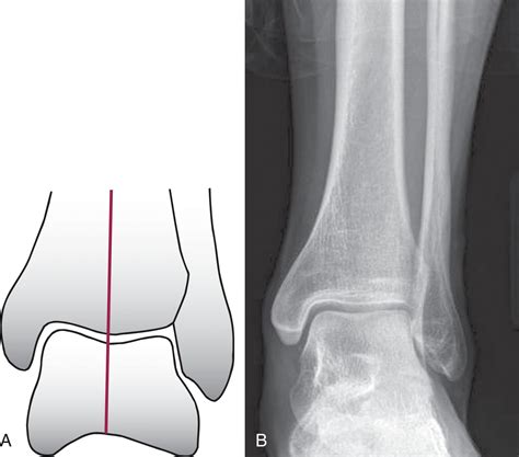 Ankle Arthritis and Arthrodesis - Clinical Tree