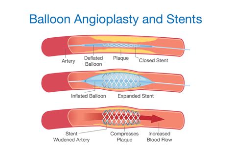 Stent einsetzen » Stentimplantation » Stent-OP » Ablauf, Fragen, Risiko: