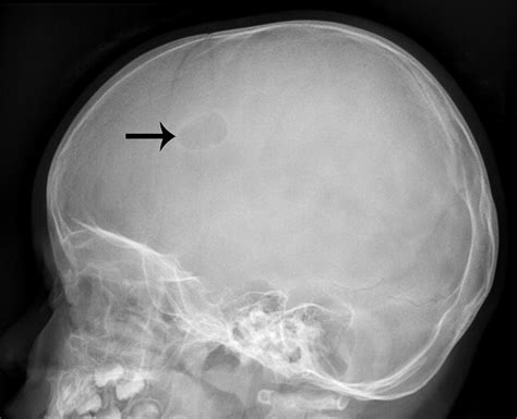 Imaging Spectrum Of Calvarial Abnormalities Radiographics