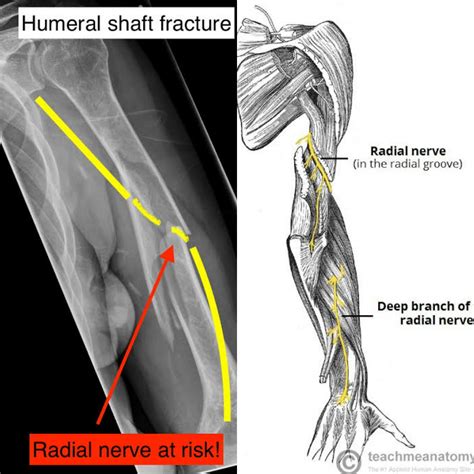 Radial Groove Radial Nerve