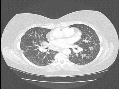 Mediastinal mass differential diagnosis - wikidoc