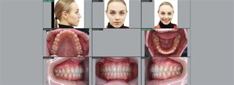 Fotografii Intraorale Extraorale Centru De Radiologie Dentara R Dental