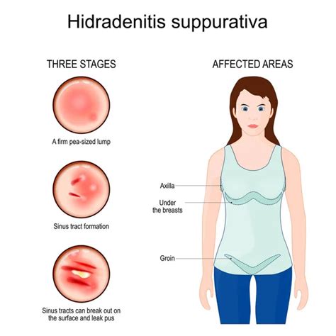 Hidradenitis Suppurativa Affected Areas Of Acne Inversa Three Stages