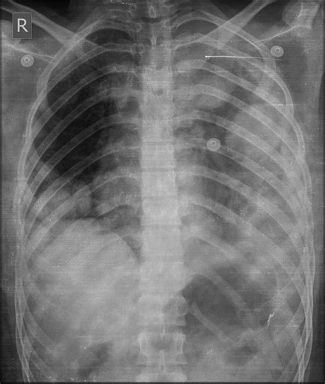 Varicose Vessels Within Pulmonary Metastasis Of Giant Cell Tumor