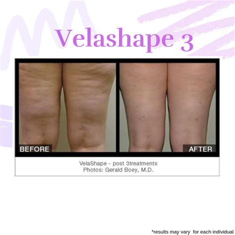 VelaShape Body Sculpting In Edmonton Bliss Medispa