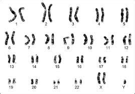 Klinefelter Syndrome - Reproductive - Medbullets Step 1