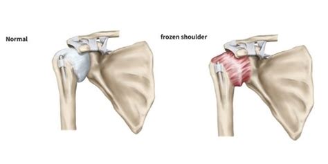 Frozen Shoulder Vs Healthy Shoulder Propel Physiotherapy Propel Physiotherapy