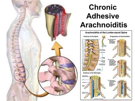 COMPLICATIONS OF SPINAL & EPIDURAL ANAESTHESIA