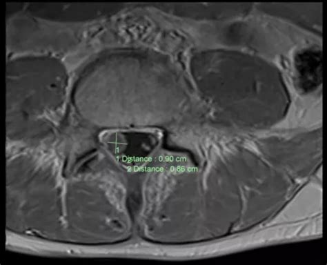 Spinal Cancer Mri - CancerWalls