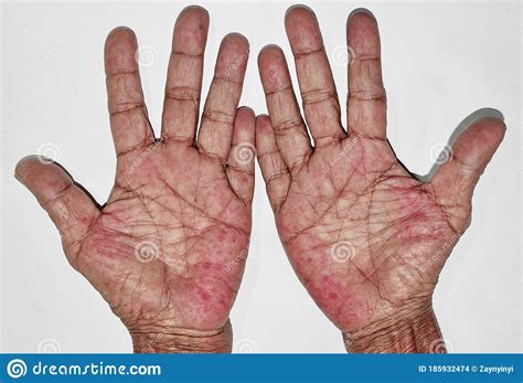 Palmar Erythema Stock Photos Free And Royalty Free Stock Photos From