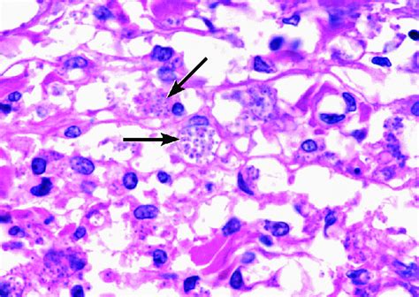 47 Macrophages Containing Multiple Amastigotes Arrows In Dermis In