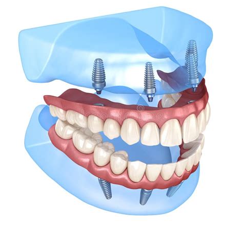 Prótesis Maxilar Y Mandibular Con Goma Todo En 4 Sistemas Soportados