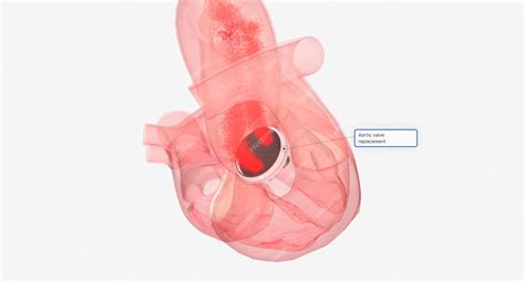 Premium Photo | Aortic valve replacement in the heart